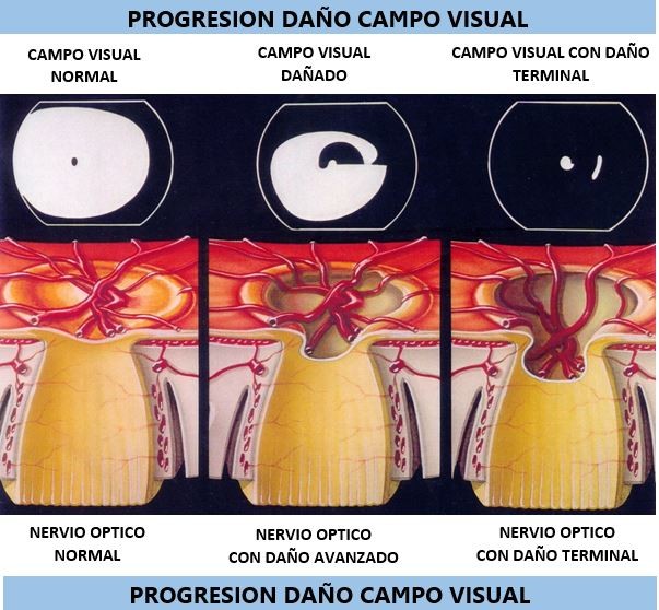 Progresión Daño CV Glauco_2