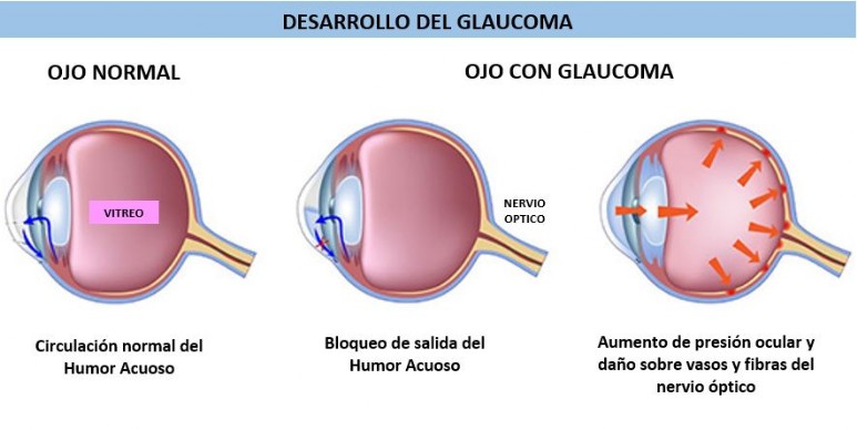 Desarrollo del Glaucoma Glauco_1