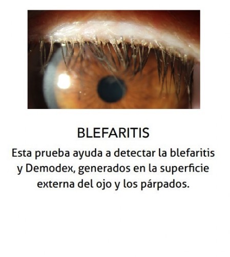 Analisis de Blefaritis