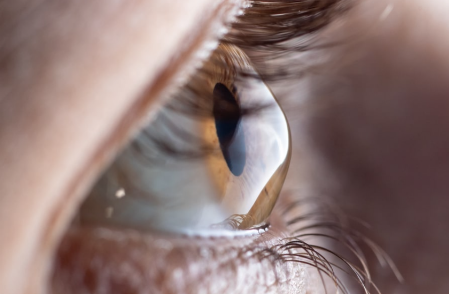 queratocono keratoconus